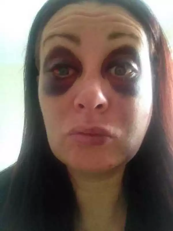 Domestic Violence; Woman Shares Daily Selfies Of Her Battered Face During Recovery To Inspire Others [Photos]